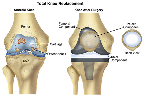 KneeReplacement-SM